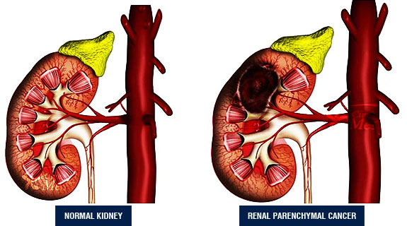 Kidney Cancer