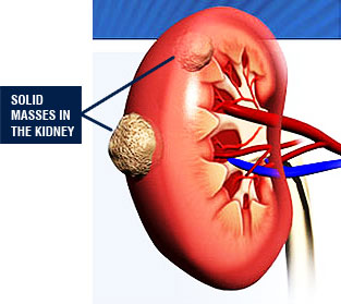 Kidney Cancer