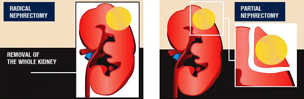 Kidney Cancer