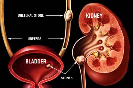 Kidney Stone