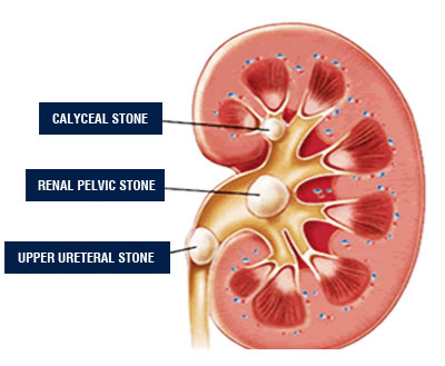 Kidney Stone