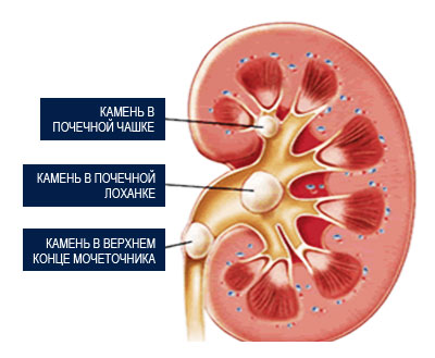 Мочекаменная Болезнь
