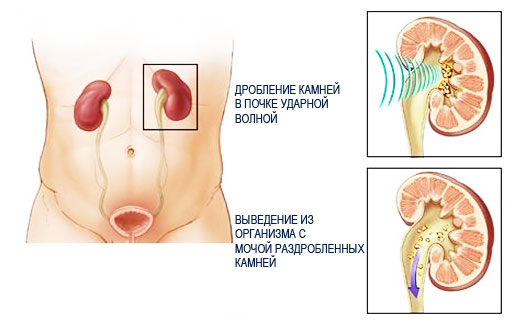 Мочекаменная Болезнь