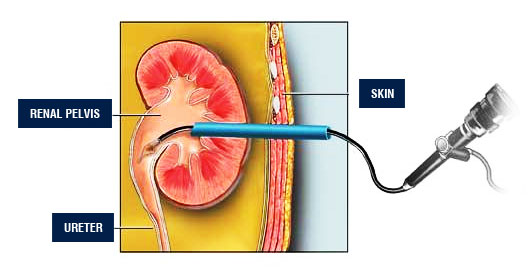 Kidney Stone