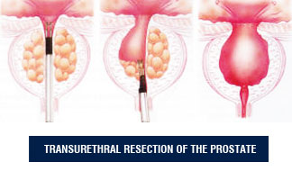 Benign Prostatic Hyperlasia (BPH)