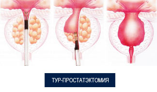 Доброкачественная гиперплазия предстательной железы (ДГПЖ)