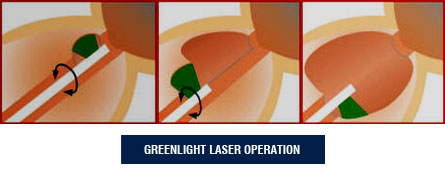 Greenlight Laser