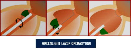 Greenlight Lazer