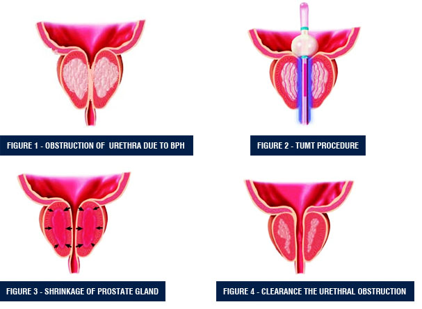 Benign Prostatic Hyperlasia (BPH)