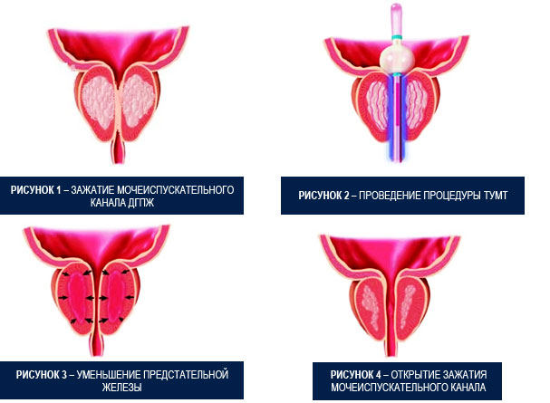 Доброкачественная гиперплазия предстательной железы (ДГПЖ)