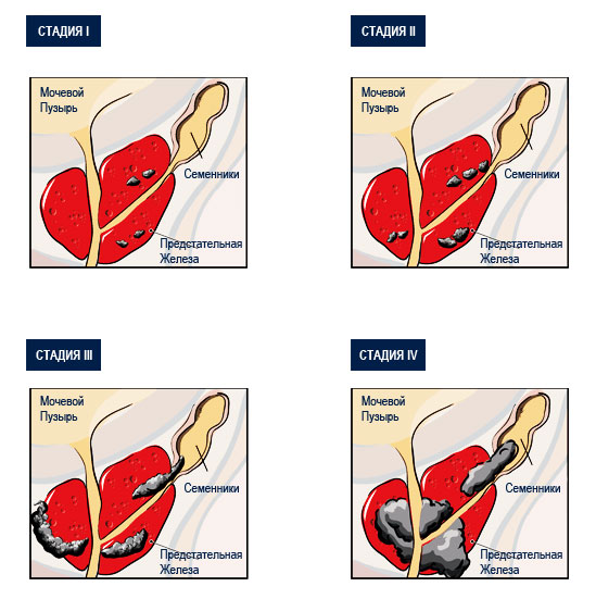 Рак Предстательной Железы