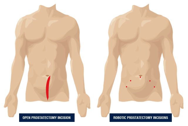 da Vinci Robotic Prostatectomy