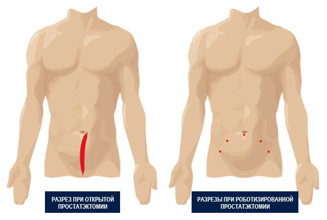 Роботизированная Радикальная Простатэктомия