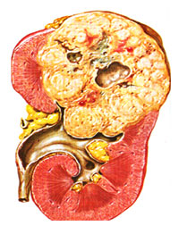 Robotik Radikal Nephrectomy