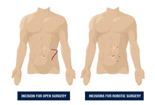 Robotik Radikal Nephrectomy